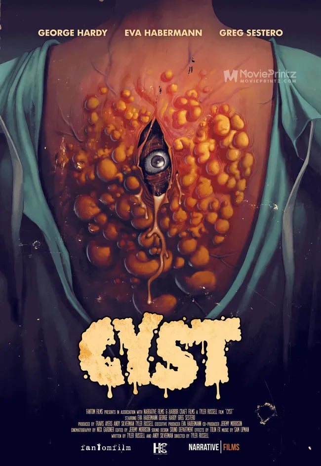 Cyst Poster